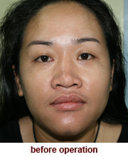 plastic_surgery_augmentation_rhinoplasty